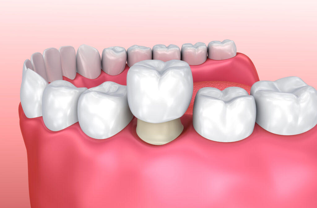 A rendered image of a dental crown, showing the cap going on top of the natural tooth.