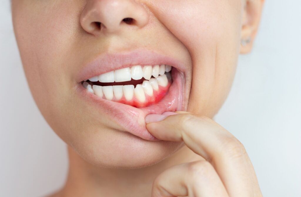A close up of a person's mouth showing red gums as they pull down their lip with 2 fingers.