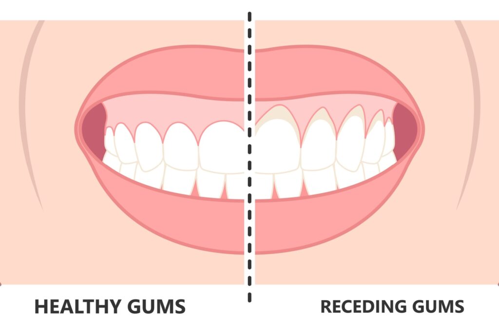 A diagram of a smile, comparing what healthy gums look like versus receding gums.